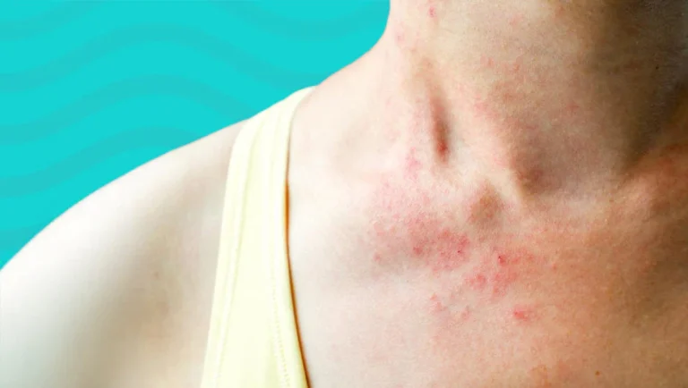 pool chlorine rash