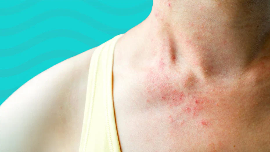 pool chlorine rash